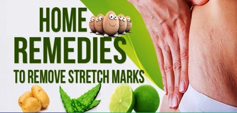 how to remove stretch marks at home